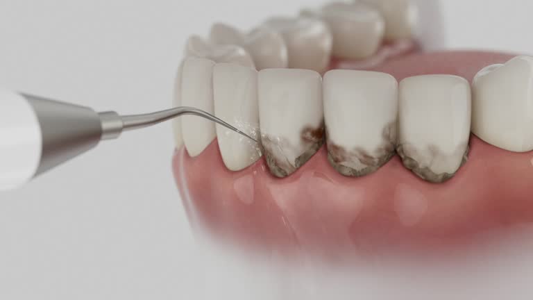 Trusted Dental Crowns And Bridges service in Castro Valley, CA - Dentist Open Now